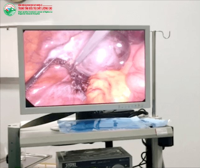 Hình ảnh tin tức PHẪU THUẬT NỘI SOI GỠ DÍNH RUỘT, CẮT BỎ U NANG BUỒNG TRỨNG VÀ LÀM SẠCH Ổ BỤNG